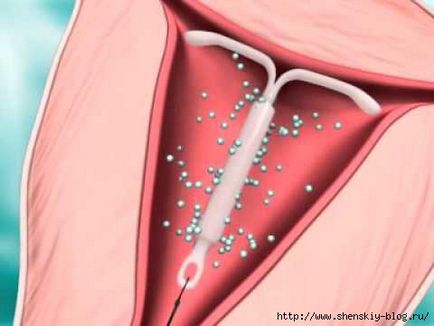 Ce trebuie făcut dacă dispozitivul intrauterin este deplasat