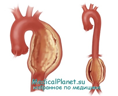 Mi atherosclerosis az aorta okok, klinikai következmények