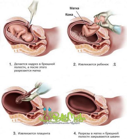 Що таке кесарів розтин під час перших і повторних пологів