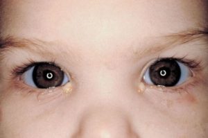 Dacryocystitis a ochiului la nou-născuți fotografie, tratament și masaj de la țânțar
