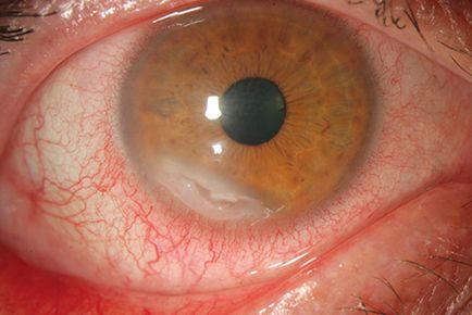 Dacryocystitis la nou-nascuti, simptome si tratament, masaj ocular cu dacryocystis congenital