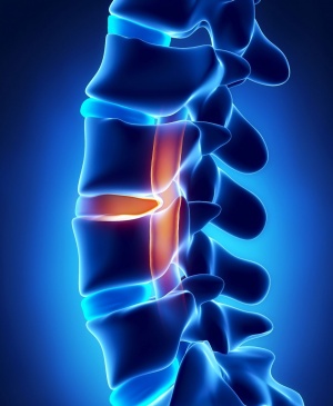 Hernia dorsală a discului intervertebral l5 s1