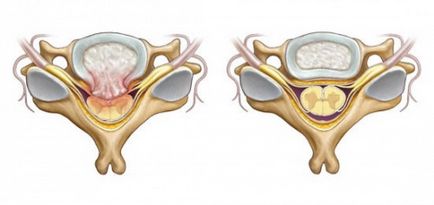 Hernia dorsală a discului intervertebral l5 s1