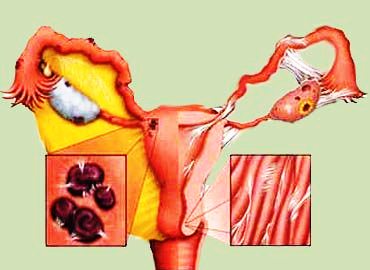 Endometriózis okok, tünetek, jelek, endometriózis kezelésére