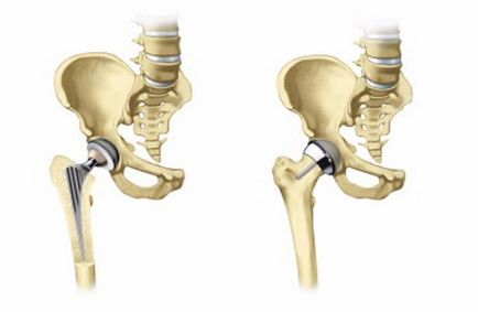 Totál endoprotézis idős betegeknél ecsto (arthroplasty) Totál endoprotézis idős betegek ecsto