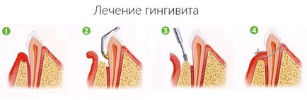 Gingivita simptome și tratament, cauze de inflamație a gingiilor - clinica eurosmile în Sankt Petersburg
