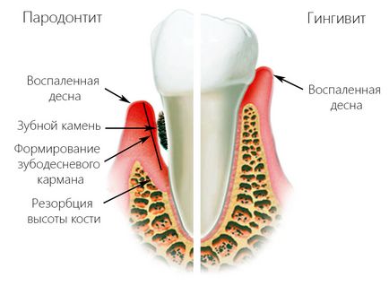 Gingivita simptome și tratament, cauze de inflamație a gingiilor - clinica eurosmile în Sankt Petersburg