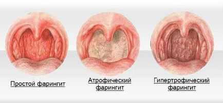 Simptome de faringită hipertrofică, tratament, cauze