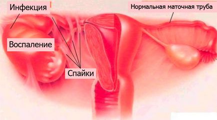 Hirudoterapia cu obstrucție a trompelor uterine