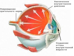 Tratamentul cu glaucom