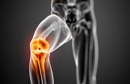 Гонартроз 4 ступеня колінного суглоба лікування і реабілітація
