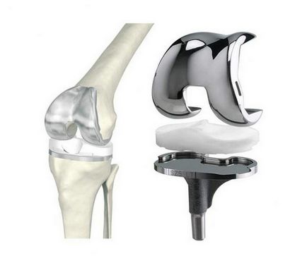 Гонартроз 4 ступеня колінного суглоба лікування і реабілітація