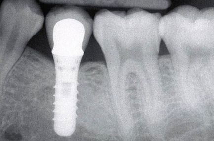 Az implantátumok Straumann fogak (fejlesztési Svájc)