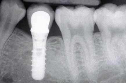 Az implantátumok Straumann fogak (fejlesztési Svájc) (fogimplantátum ár) Az implantátumok Straumann fogak (fejlesztési Svájc)
