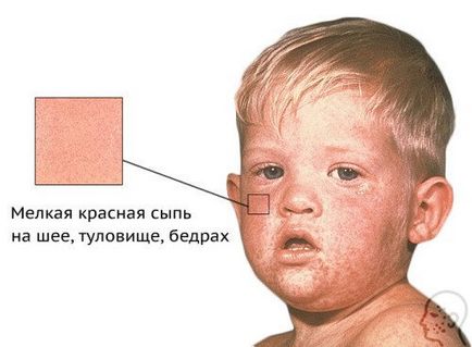 Інфекційний дерматит лікування, фото, у дітей і дорослих