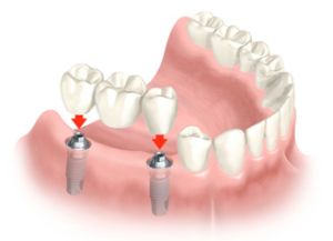 Cortexul implant cortex (cortex) israelian, tipuri, caracteristici, recenzii, preturi