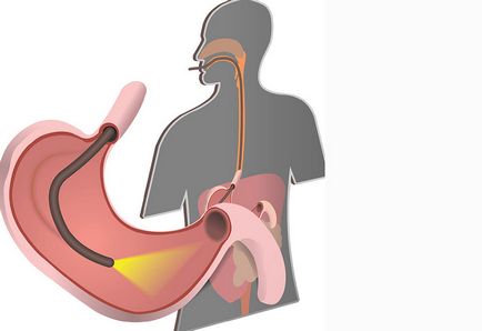 Cât de des poți face o gastroscopie?