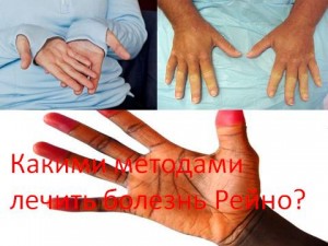 Care sunt metodele pentru tratarea bolii Raynaud?