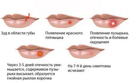 Як позбутися від герпесу рішення проблеми