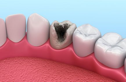 Cum să scapi de locul de dezintegrare a dinților de fizioterapie în timpul tratamentului