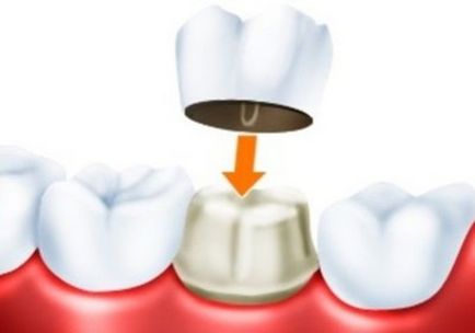 Як ставлять коронку на зуб
