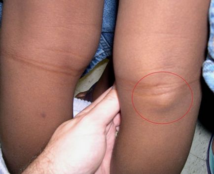 Кіста Бейкера колінного суглоба, причини виникнення підколінної кісти