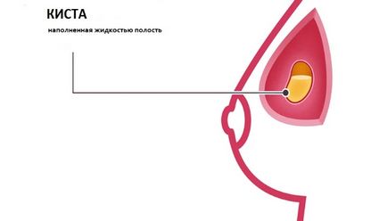 Chistul tipurilor de glandă mamară ce să facă și dacă această boală este periculoasă