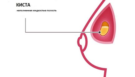 Кіста молочної залози види, що робити і небезпечно ця хвороба