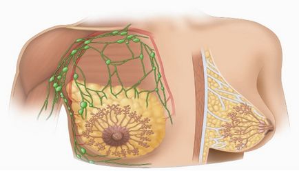 Chistul tipurilor de glandă mamară ce să facă și dacă această boală este periculoasă