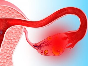 Chistul hemoragic în ovar, caracteristicile manifestării și tipurile de intervenție chirurgicală