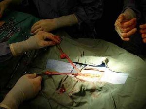 Кіста з крововиливом в яєчнику, особливості прояву та види хірургічного втручання