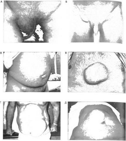 Clasificarea herniilor abdominale, clinica hernie abdominală - chirurgie - material online on-line