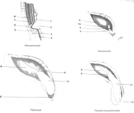 Класификация на коремна херния, коремна херния клиника - Хирургия - navchalnі materіali онлайн