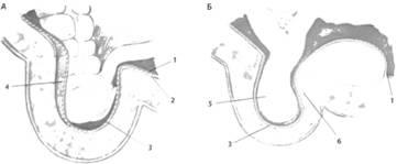 Clasificarea herniilor abdominale, clinica hernie abdominală - chirurgie - material online on-line