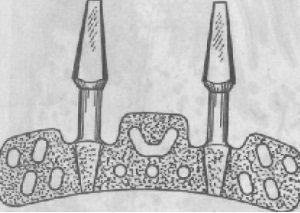 Structurile de implant