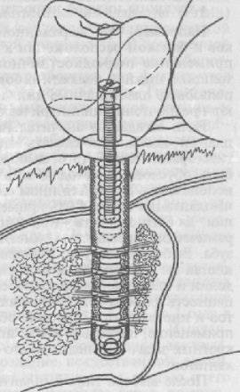 Structurile de implant