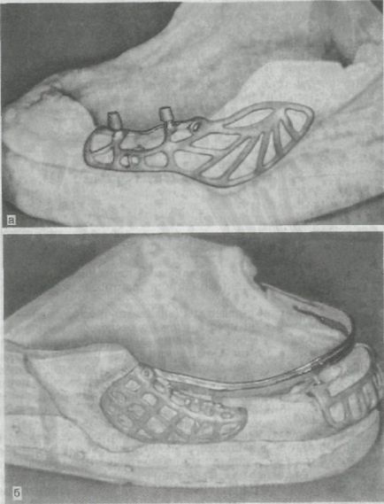 Structurile de implant