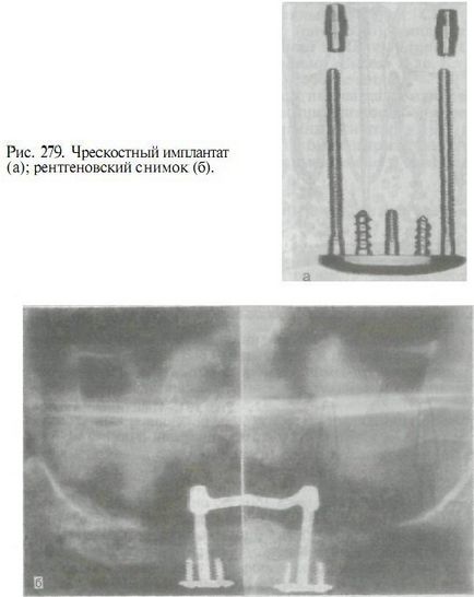 Structurile de implant