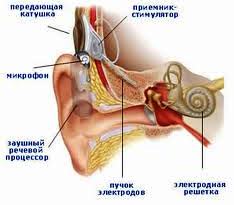 Cochlear implant