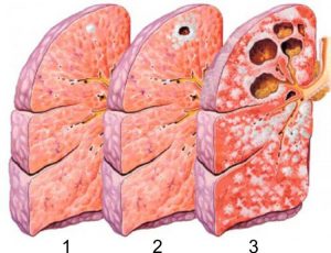 Fumatul cu tuberculoză pulmonară este posibil sau nu