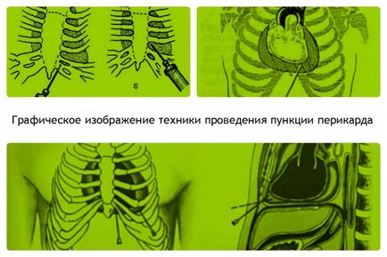 Лікувальні процедури при гострому і хронічному перикардиті, терапевтичне і хірургічне лікування,