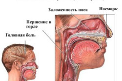 Tratamentul sinuzitei cu peroxid de hidrogen