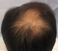 Tratamentul alopeciei, transplantul de par Ekaterinburg, Perm, Chelyabinsk, Nizhny Tagil, Tyumen, Ufa,