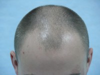 Tratamentul alopeciei, transplantul de par Ekaterinburg, Perm, Chelyabinsk, Nizhny Tagil, Tyumen, Ufa,