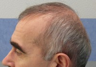 Tratamentul alopeciei, transplantul de par Ekaterinburg, Perm, Chelyabinsk, Nizhny Tagil, Tyumen, Ufa,