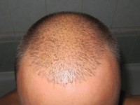 Tratamentul alopeciei, transplantul de par Ekaterinburg, Perm, Chelyabinsk, Nizhny Tagil, Tyumen, Ufa,