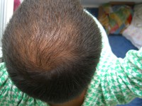 Tratamentul alopeciei, transplantul de par Ekaterinburg, Perm, Chelyabinsk, Nizhny Tagil, Tyumen, Ufa,