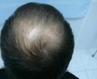 Tratamentul alopeciei, transplantul de par Ekaterinburg, Perm, Chelyabinsk, Nizhny Tagil, Tyumen, Ufa,