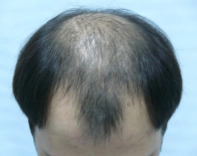 Tratamentul alopeciei, transplantul de par Ekaterinburg, Perm, Chelyabinsk, Nizhny Tagil, Tyumen, Ufa,