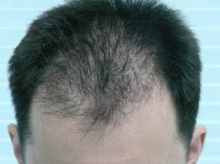 Tratamentul alopeciei, transplantul de par Ekaterinburg, Perm, Chelyabinsk, Nizhny Tagil, Tyumen, Ufa,